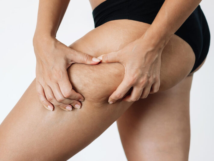 Zabieg Storz na cellulit i tkankę tłuszczową – kiedy warto go wykonać?